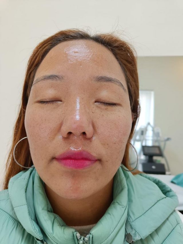 (After) Hydrafacial for Freckels removal.jpg