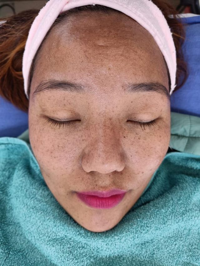 (Before) Hydrafacial for Freckels removal