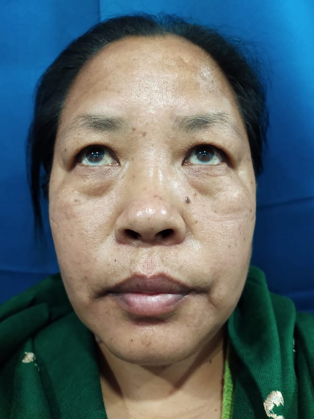 Blepharoplasty before