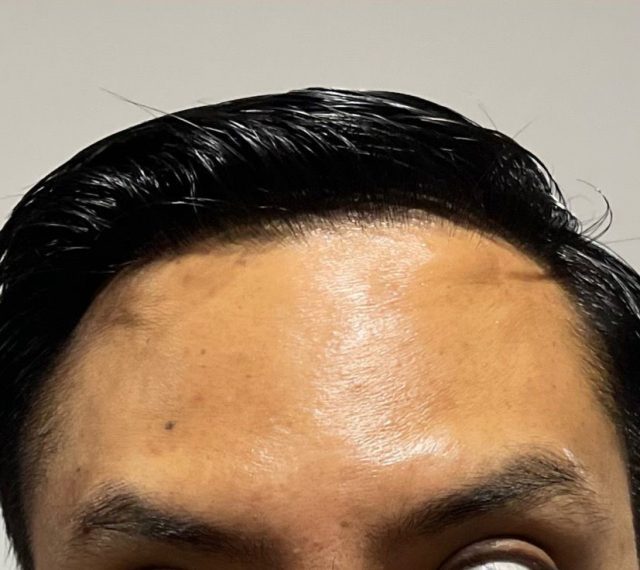 Botox for Wrinkles Removal (After)