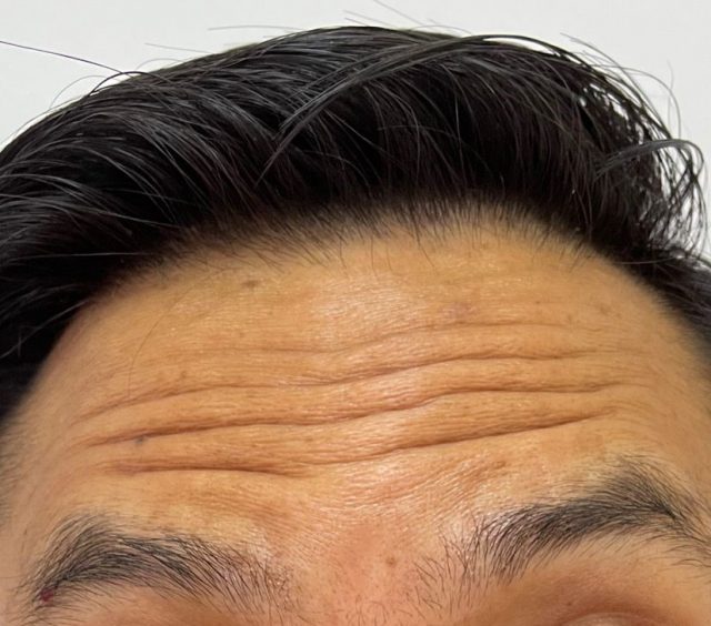 Botox for Wrinkles Removal (Before)