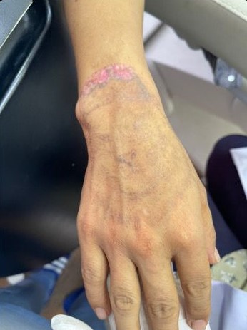 Pico Laser for Tattoo removal (After)