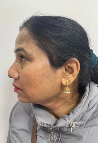 cosmelan for melasma (after)