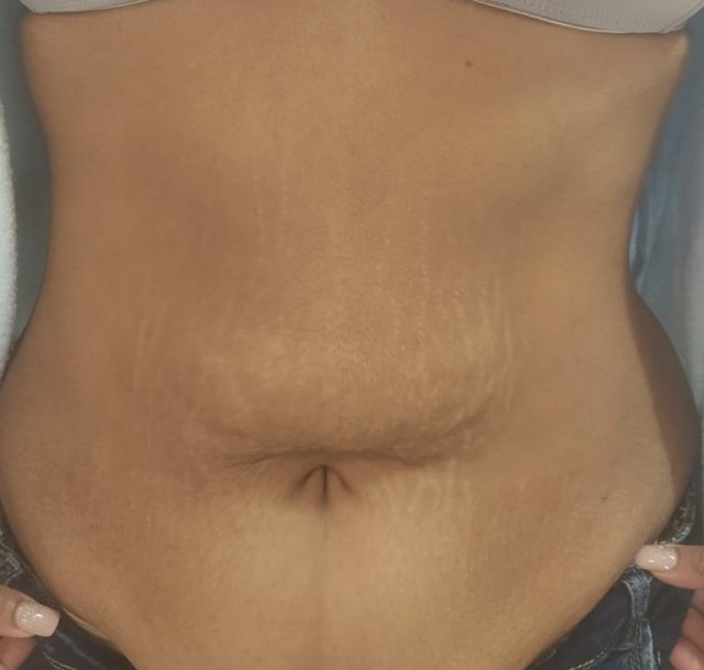 velashape after