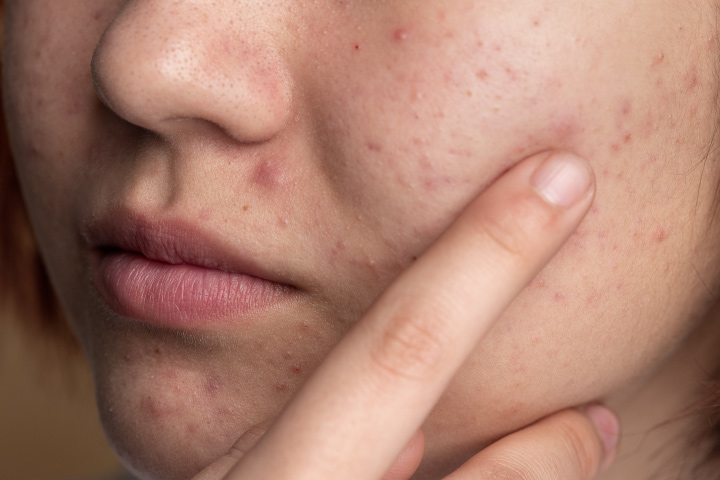 https://healthychoicenepal.com/wp-content/uploads/2023/04/close-up-skin-acne.jpg