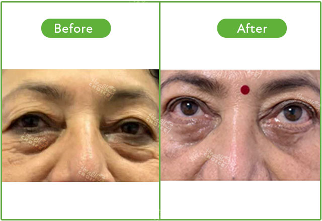 https://healthychoicenepal.com/wp-content/uploads/2023/05/Blepharoplasty3.jpg