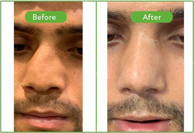 Crooked Nose Correction Rhinoplasty