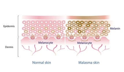 https://healthychoicenepal.com/wp-content/uploads/2023/05/normal-skin-layer-melasma-vector-260nw-2133311457.jpg