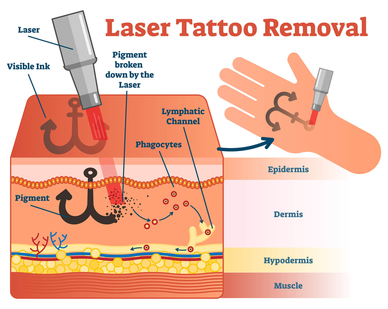 https://healthychoicenepal.com/wp-content/uploads/2023/05/tattoo-removal-anatomy.jpg