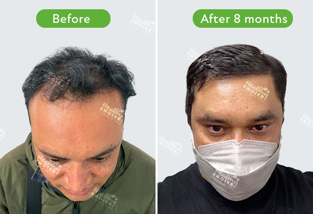 Before And After | Healthy Choice Aesthetic Hospital