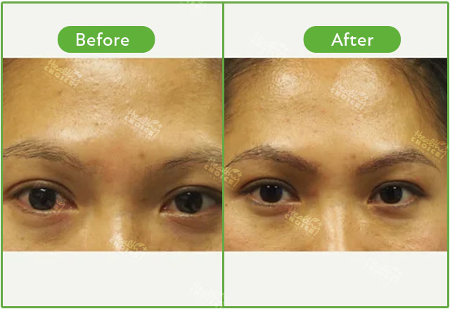 https://healthychoicenepal.com/wp-content/uploads/2023/06/eyebrow.jpg