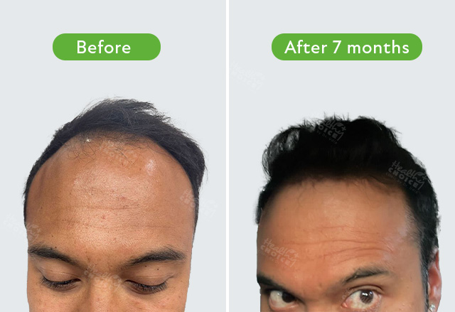 https://healthychoicenepal.com/wp-content/uploads/2023/07/Hikmat-shrestha-3500-graft-7-month.jpg