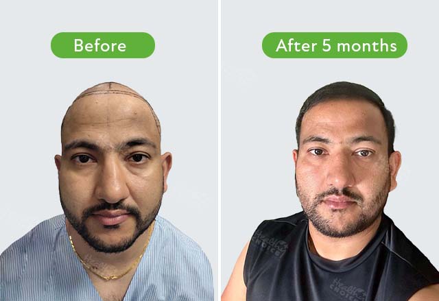 https://healthychoicenepal.com/wp-content/uploads/2023/08/Hem-adhikari-4711-graft-after-6-month-completed.jpg