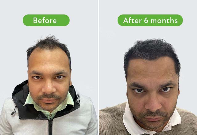 https://healthychoicenepal.com/wp-content/uploads/2023/08/Pramit-k-Gupta-4045-graft-after-6-month.jpg