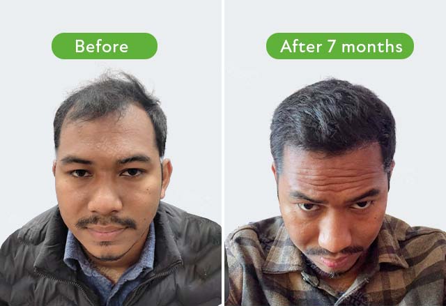 https://healthychoicenepal.com/wp-content/uploads/2023/09/Manish-shrestha-3500-graft-after-7-month.jpg