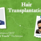 hair transplantation journey of manoj kc at Healthy Choice Clinic