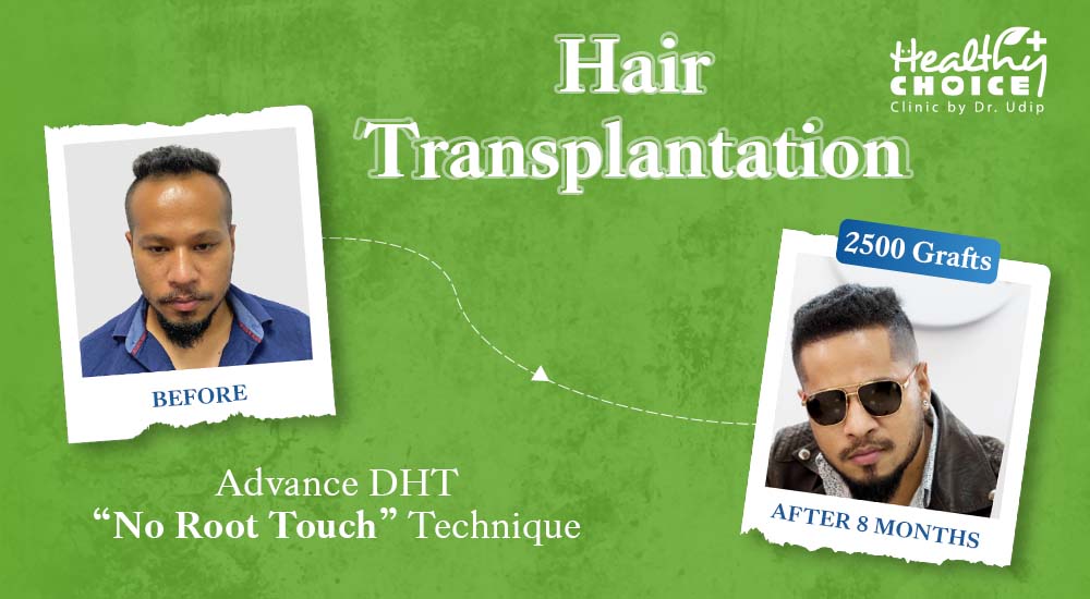 Hair Transplantation Journey of Manoj KC at Healthy Choice Clinic