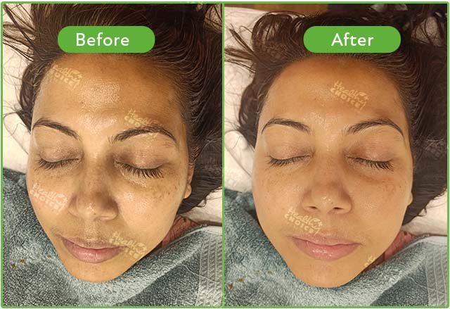 HydraFacial before after result at Healthy Choice Clinic