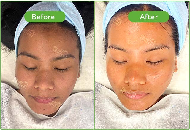 HydraFacial result at Healthy Choice Clinic