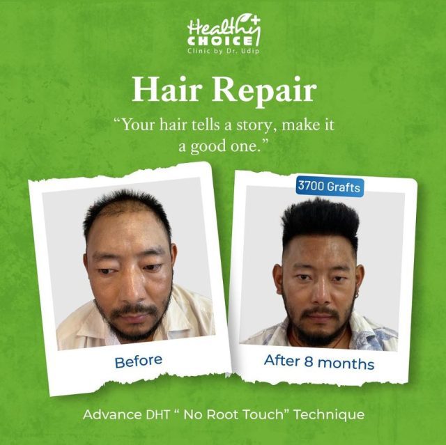 https://healthychoicenepal.com/wp-content/uploads/2023/10/best-hair-transplant-cost-in-nepal-640x639.jpg