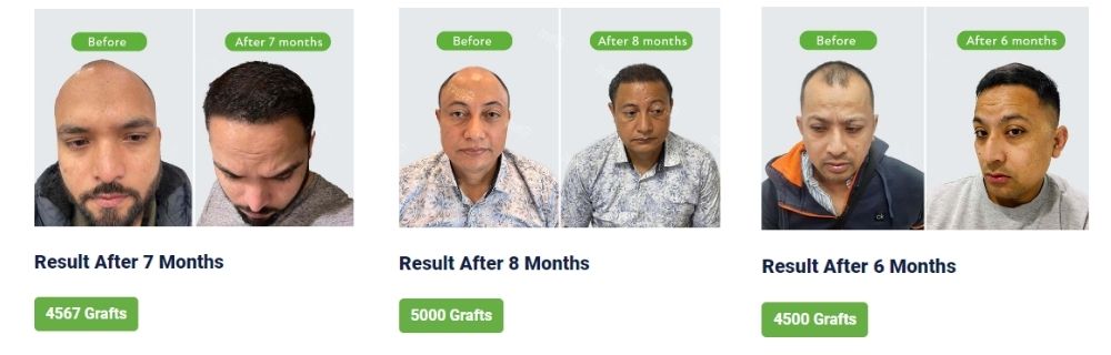 best hair transplantation in nepal dht with no root touch technique