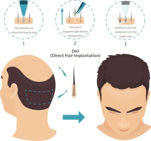 https://healthychoicenepal.com/wp-content/uploads/2023/10/hair-transplantation-in-nepal-dhi-640x596.jpg