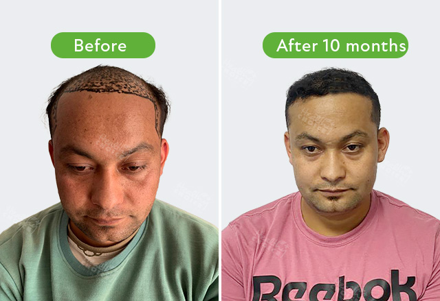 NABIN THAPA_5500 GRAFT AFTER 10 MONTHS hair transplantation in nepal healthy choice clinic
