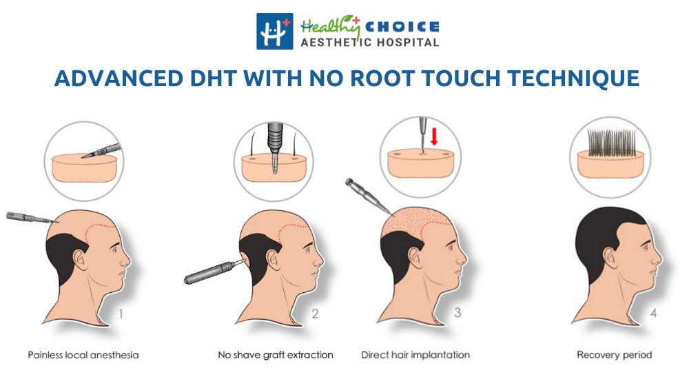 Best hair transplant in nepal advanced direct hair transplant with no root touch technique