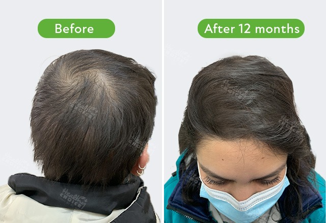 https://healthychoicenepal.com/wp-content/uploads/2024/01/best-female-hair-transpalnt-result-in-nepal-healthy-choice-aesthetic-hospital.jpg