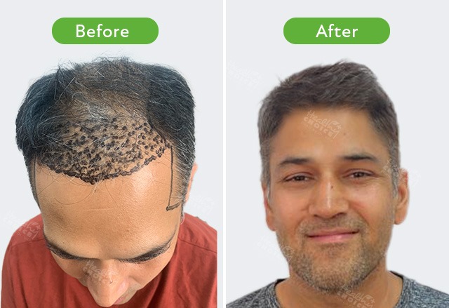 best hair transpalnt result in nepal healthy choice aesthetic hospital 3