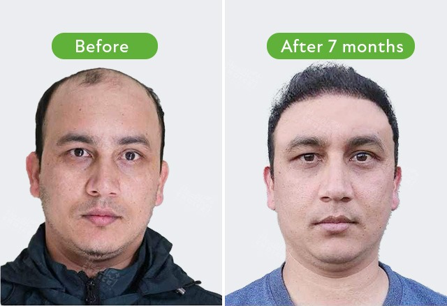 best hair transpalnt result in nepal healthy choice aesthetic hospital