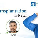 best hair transplant in nepal healthy choice aesthetic hospital