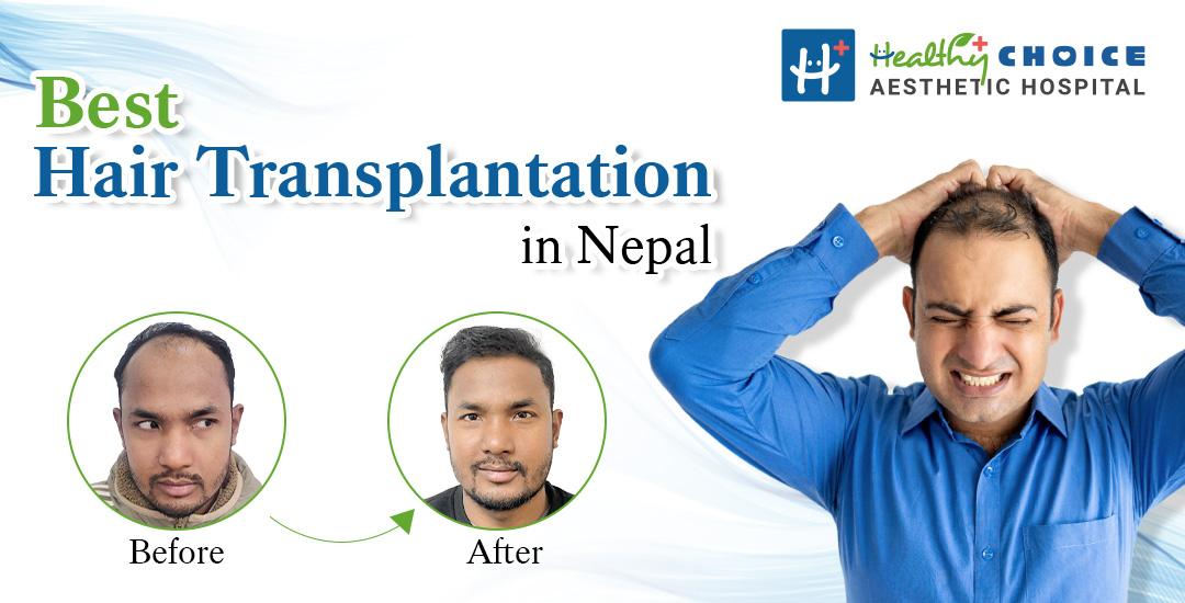 Best Hair Transplant in Nepal | Advanced Direct Hair Transplant With No Root Touch Technique