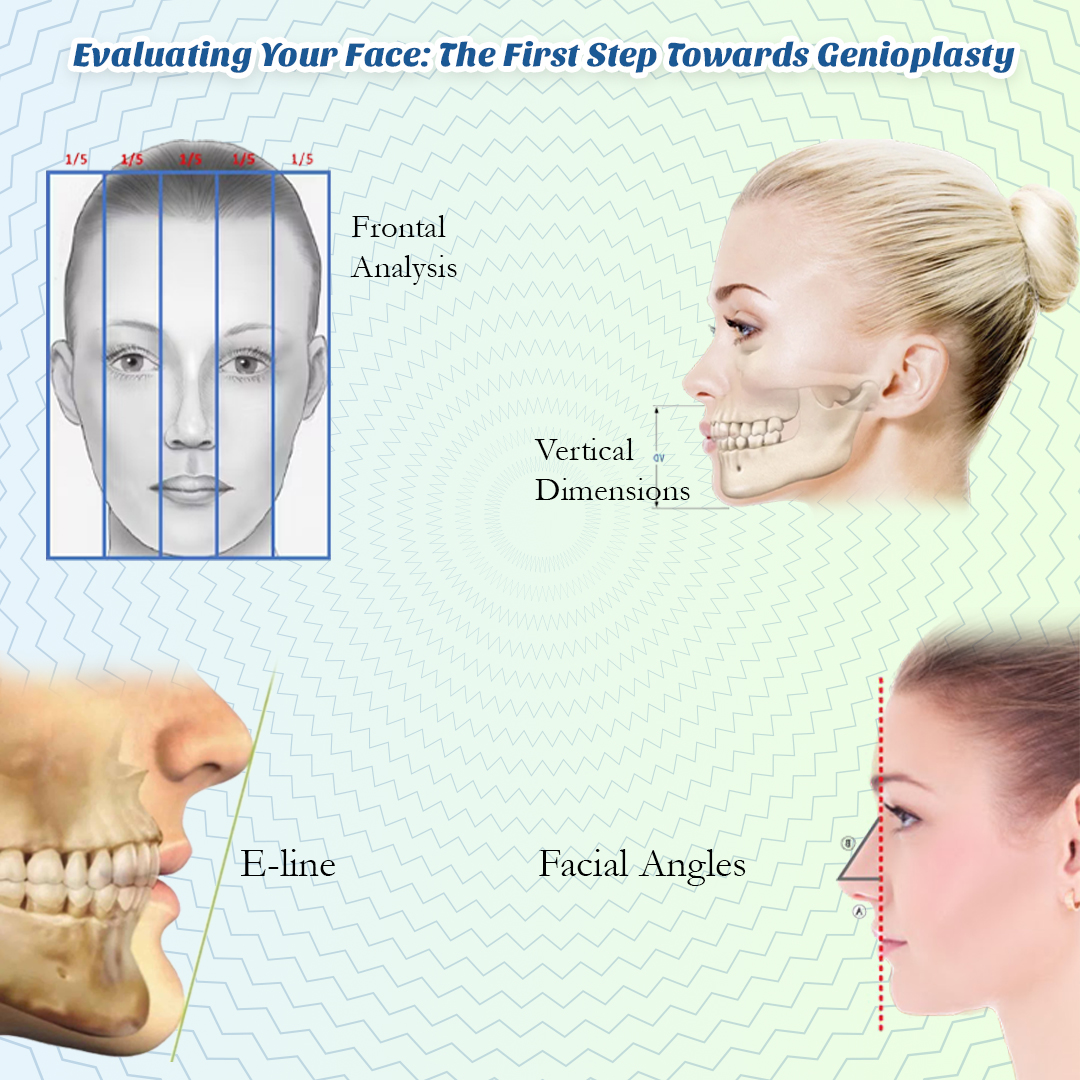 Evaluating Your Face: The First Step Towards Genioplasty