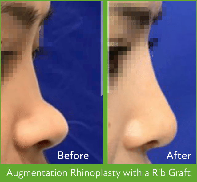 Rhinoplasty in Nepal - Bulbous Nose Treatment - Best rhinoplasty hospital in Nepal