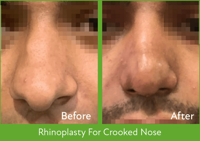 Rhinoplasty in Nepal - Crooked Nose Treatment - Best rhinoplasty hospital in Nepal