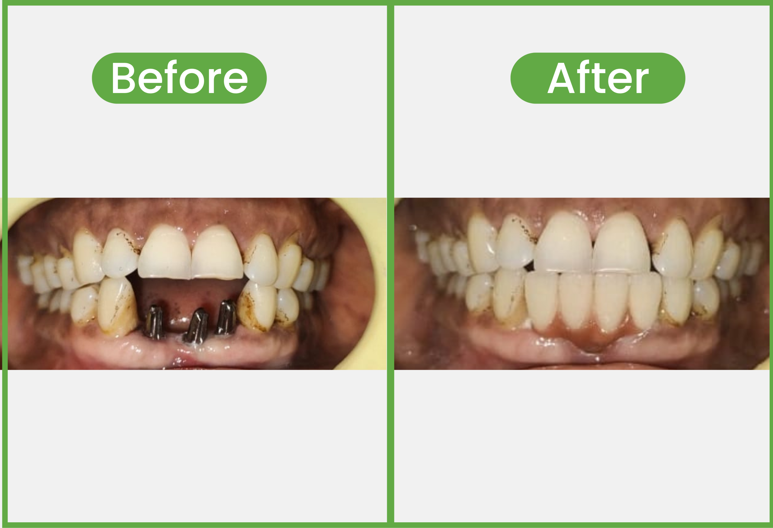 https://healthychoicenepal.com/wp-content/uploads/2025/07/Dental-before-after-dental-implant-3-scaled.png