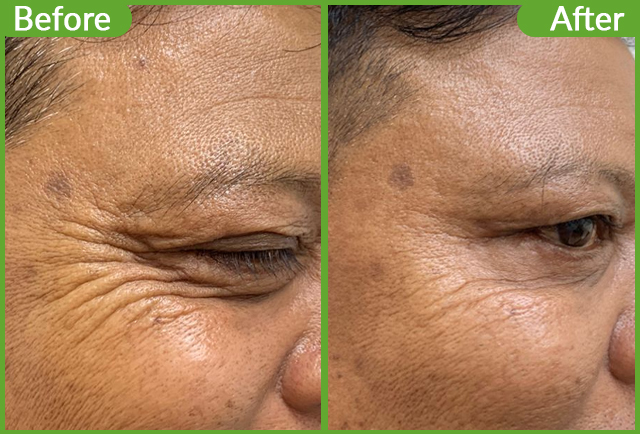 https://healthychoicenepal.com/wp-content/uploads/2025/10/Botox-Before-after-copy.jpg