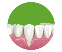 Gum Recession (1) https://healthychoicenepal.com/wp-content/uploads/2025/12/Gum-Recession-1.png