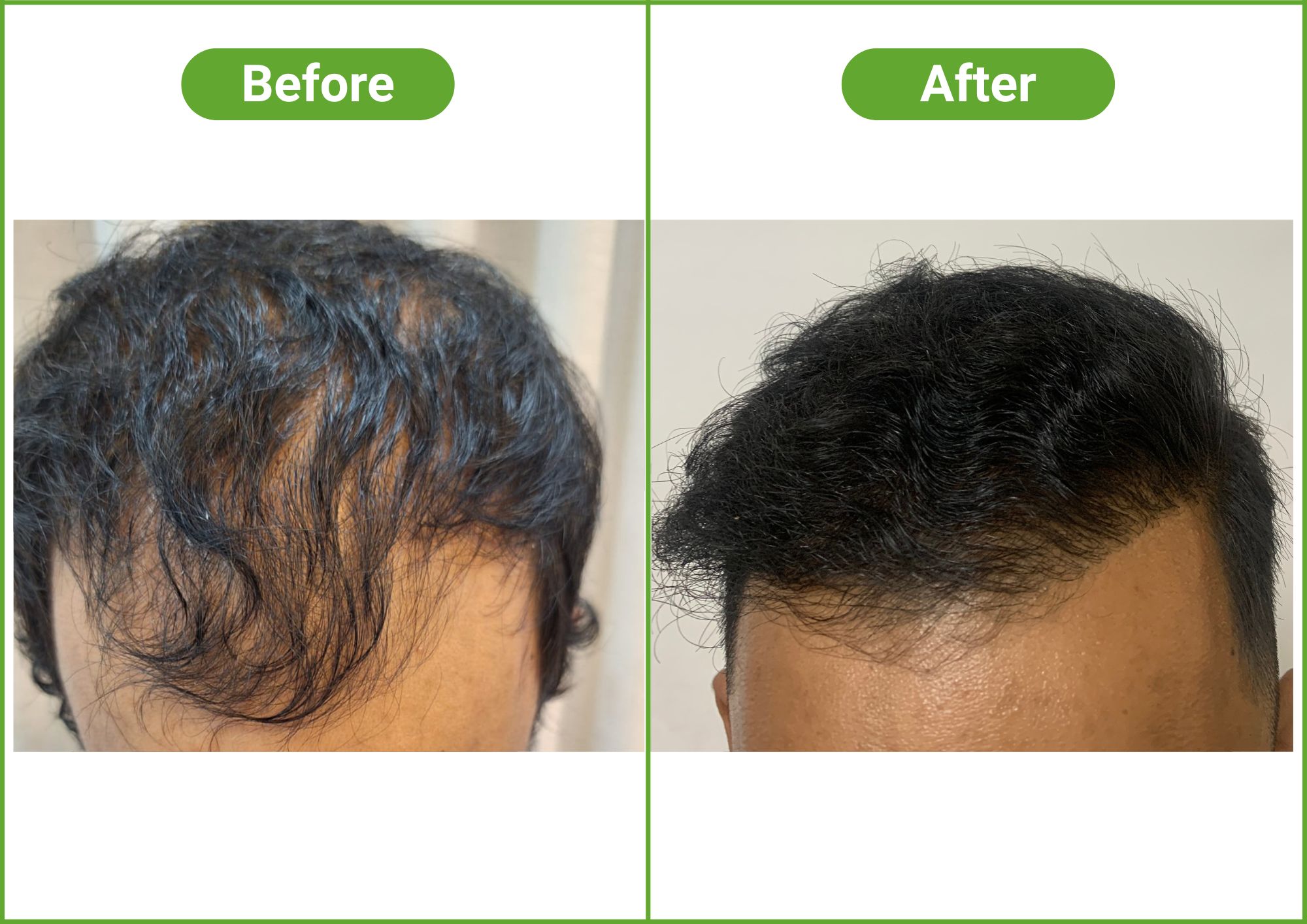 https://healthychoicenepal.com/wp-content/uploads/2025/12/Hair-Transplant-1.jpg
