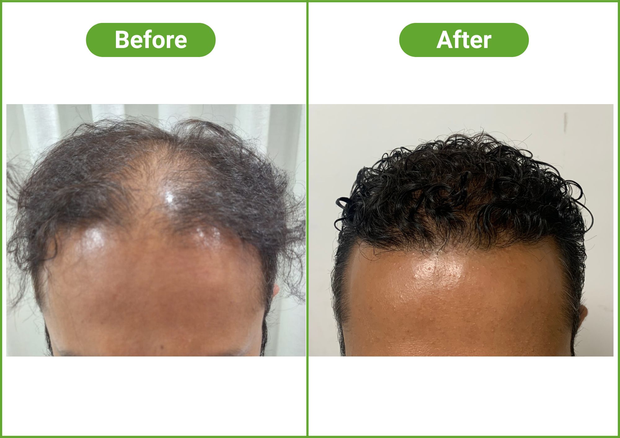 https://healthychoicenepal.com/wp-content/uploads/2025/12/Hair-Transplant-2.jpg