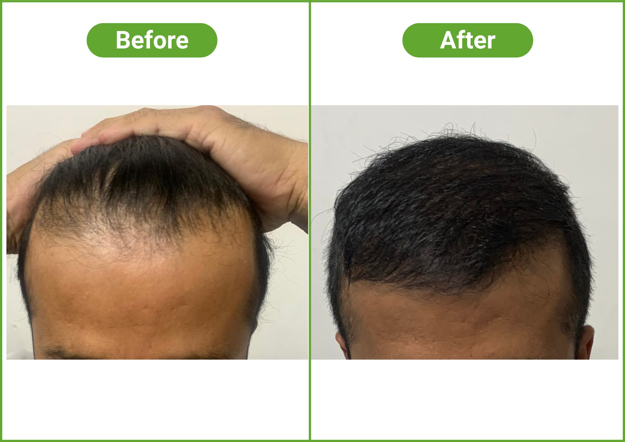https://healthychoicenepal.com/wp-content/uploads/2025/12/Hair-Transplant.jpg