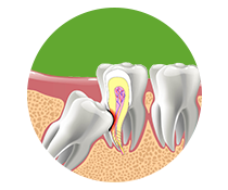 Impacted Tooth (1) https://healthychoicenepal.com/wp-content/uploads/2025/12/Impacted-Tooth-1.png