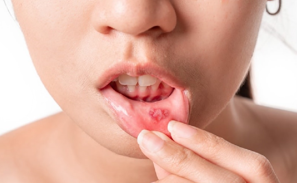 https://healthychoicenepal.com/wp-content/uploads/2025/12/Mouth-ulcer-on-lip.jpg