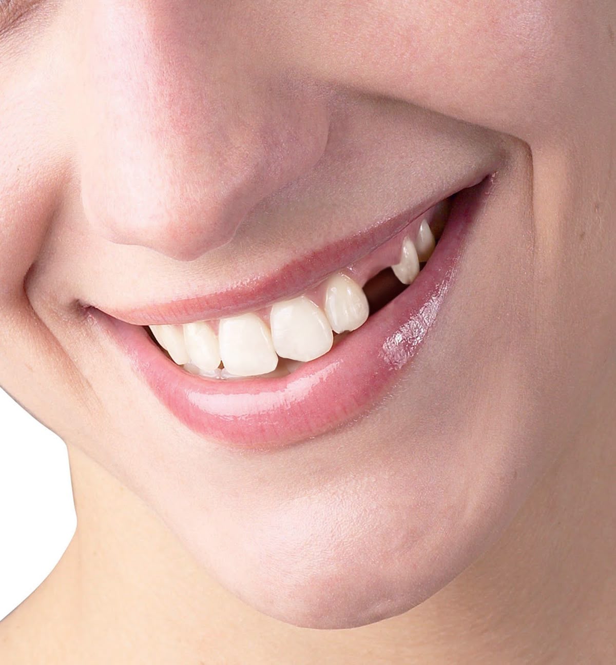 https://healthychoicenepal.com/wp-content/uploads/2026/04/missing-teeth.jpg