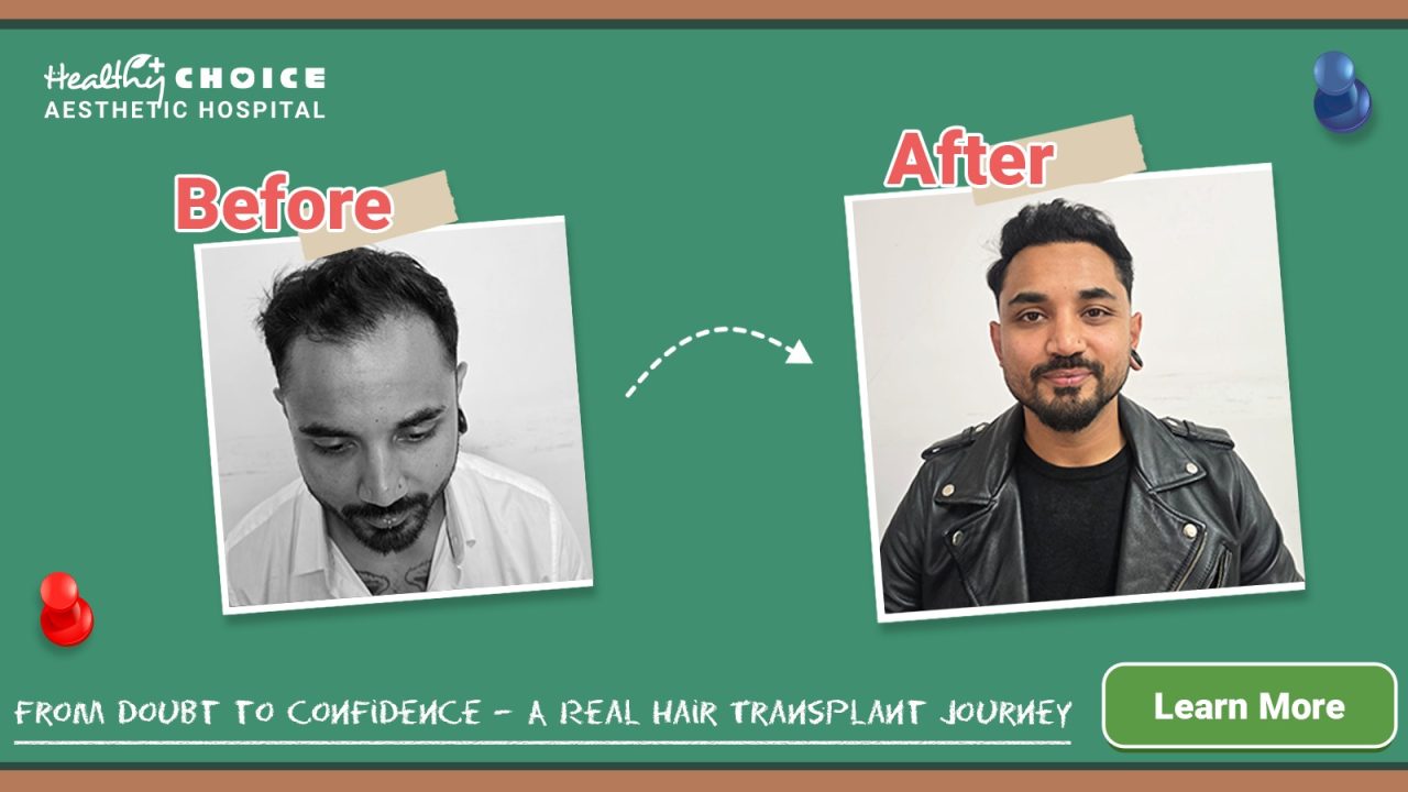 Satish Raj Bhandari’s Hair Restoration Journey: A Planned Hair Transplant