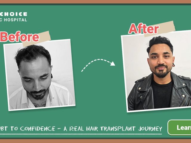 Satish Raj Bhandari’s Hair Restoration Journey: A Planned Hair Transplant Satish Raj Bhandari’s Hair Restoration Journey: A Planned Hair Transplant