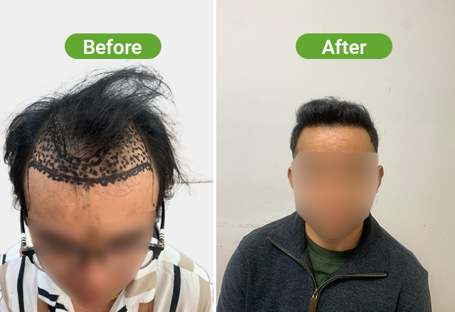 https://healthychoicenepal.com/wp-content/uploads/2026/07/Website-3054-grafts-18-months.png