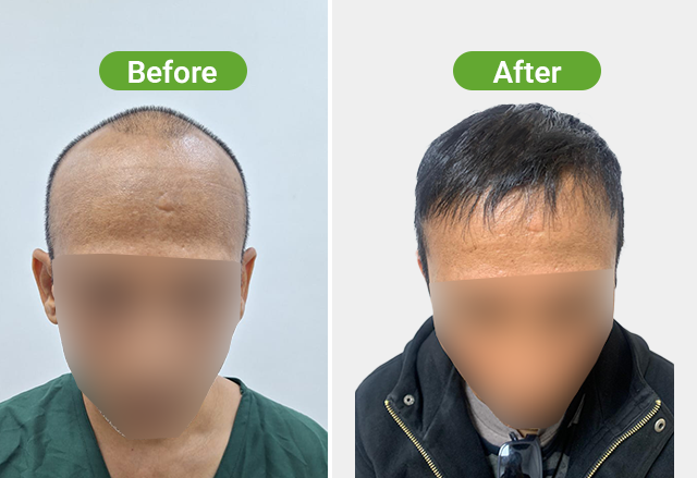 https://healthychoicenepal.com/wp-content/uploads/2026/07/Website-3500-grafts-6-months.png