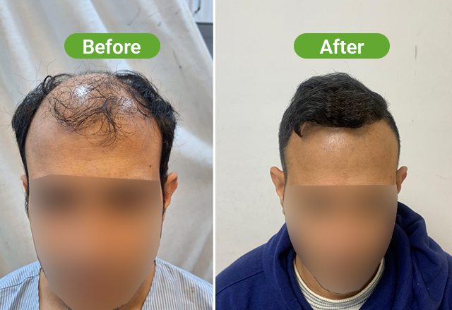 https://healthychoicenepal.com/wp-content/uploads/2026/07/Website-5000-grafts-12-months.png